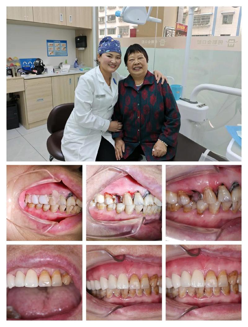 全瓷冠桥修复和种牙有何区别？牙齿缺失选哪个好？-图2