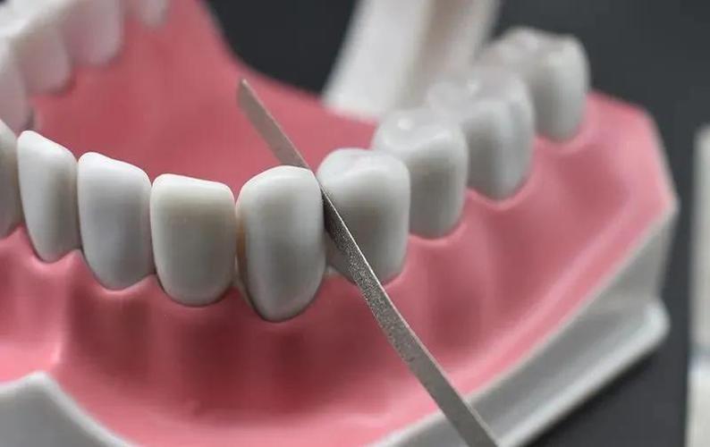 正畸邻面去釉有危害吗？专业解析潜在风险与应对措施-图2