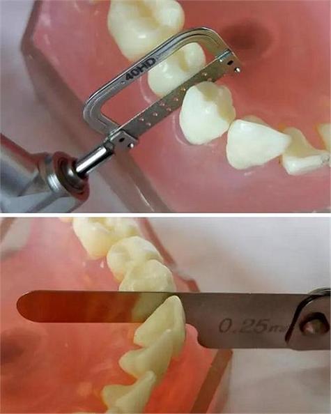 正畸邻面去釉有危害吗?专业解析潜在风险与应对措施-图3 正畸邻面去釉有危害吗?专业解析潜在风险与应对措施-图3