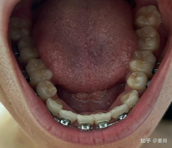 上颚正畸为何要装横杠？它的作用和感受是怎样的？-图3