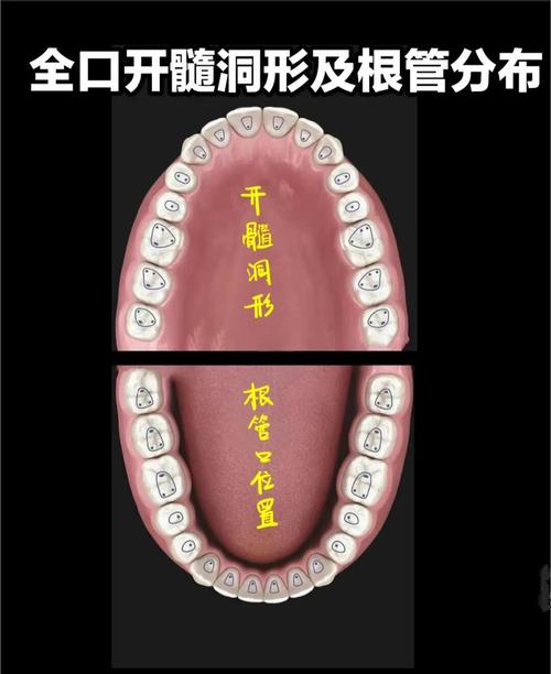 八种揭开髓室顶的方法-图1 八种揭开髓室顶的方法-图1