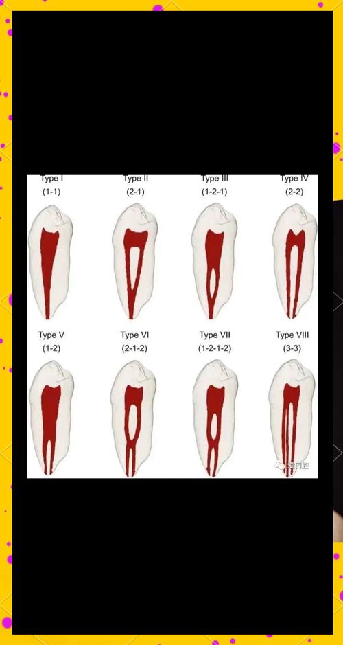 八种揭开髓室顶的方法-图2 八种揭开髓室顶的方法-图2