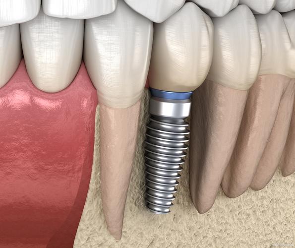 种牙骨究竟是什么样子的？种植牙手术中骨头的真实形态与结构解析-图3