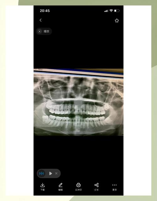 正畸拔4颗牙后智齿萌出，是矫正影响还是自然生长？-图2