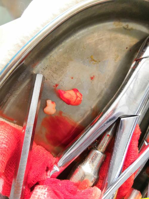 正畸拔4颗牙后智齿萌出，是矫正影响还是自然生长？-图3