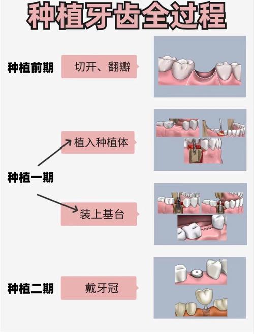 植牙技术到底是什么？原理与效果如何？-图2