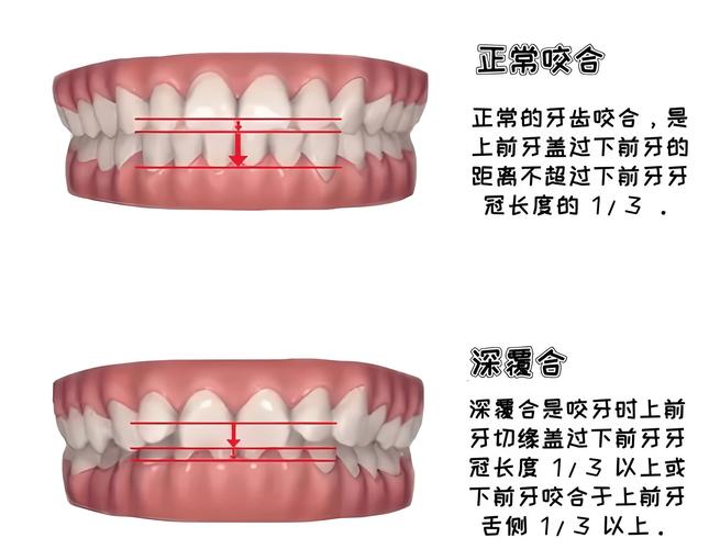 牙齿深覆合能种牙吗-图1 牙齿深覆合能种牙吗-图1