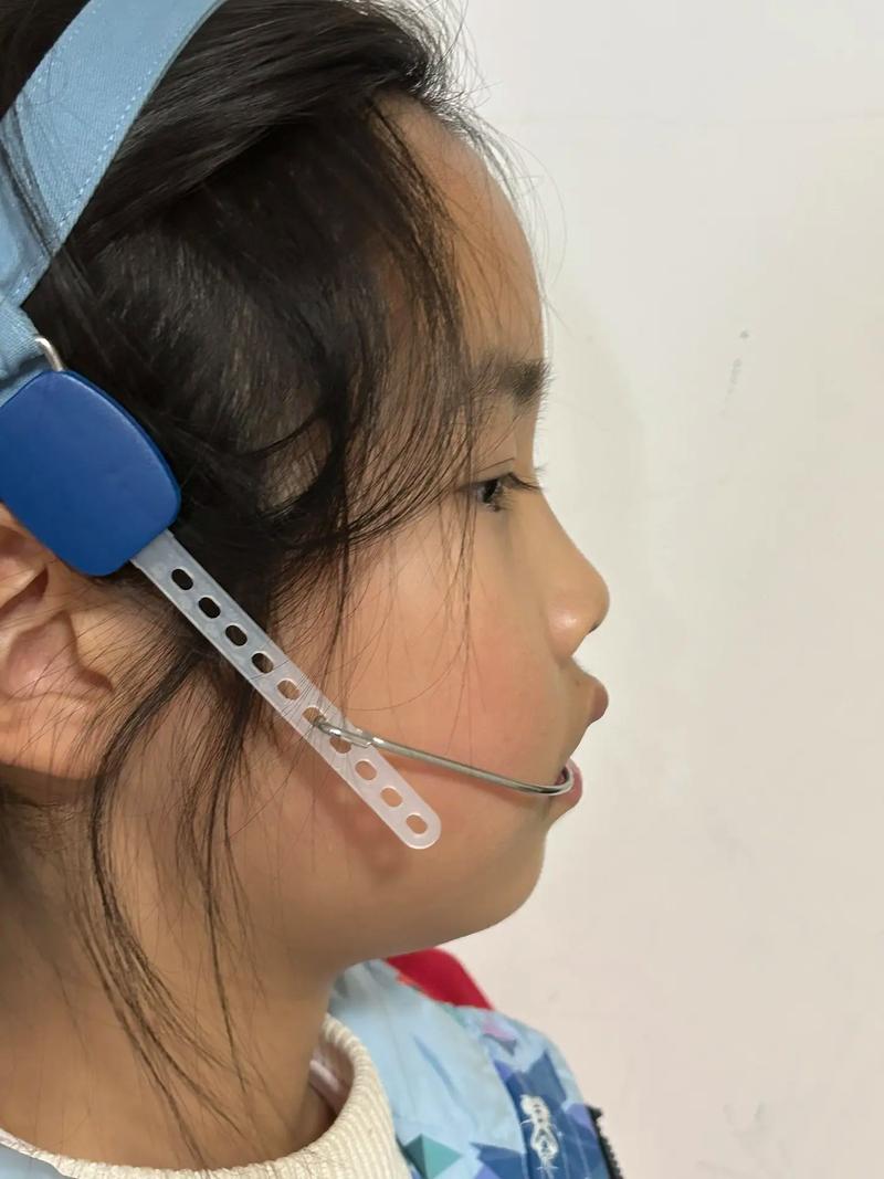 正畸头帽矫正器的适应症具体包括哪些口腔情况？-图1