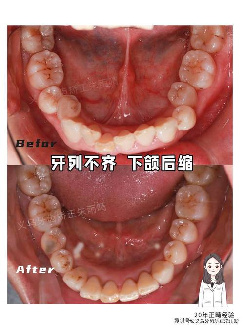正畸结束后为何不满意？效果未达预期还是护理有疏漏？-图3
