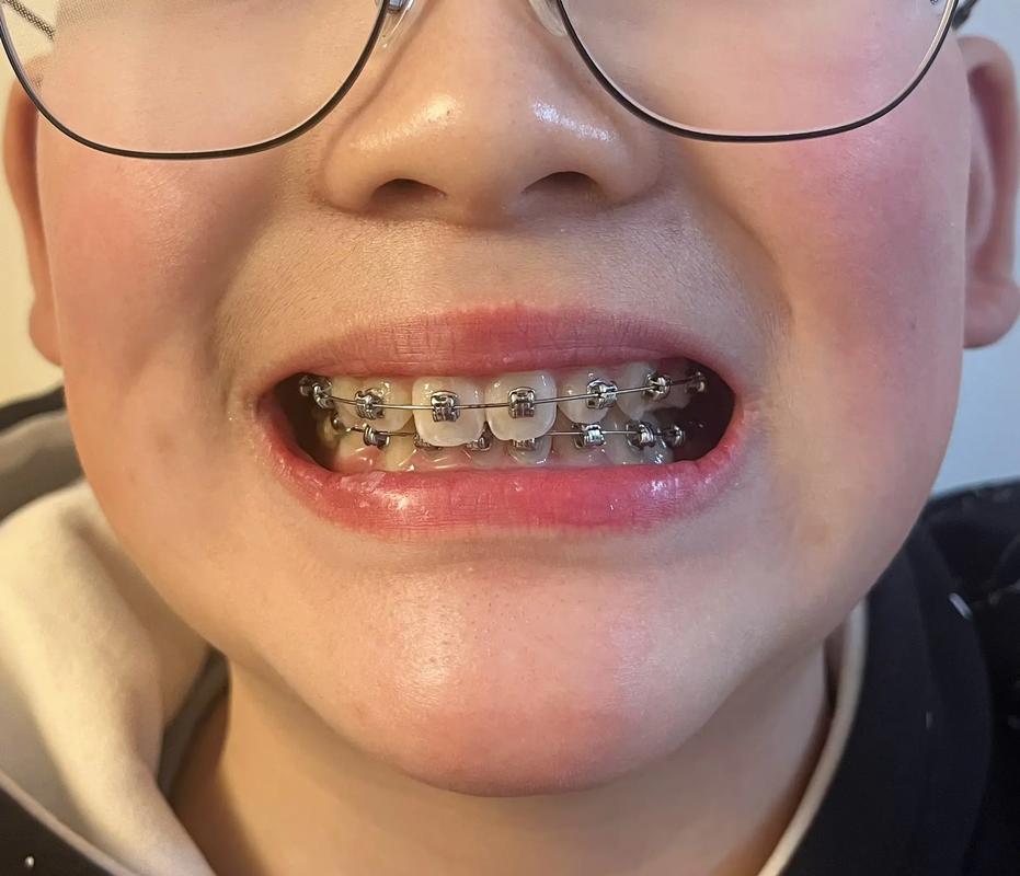 正畸结束后为何不满意？效果未达预期还是护理有疏漏？-图2