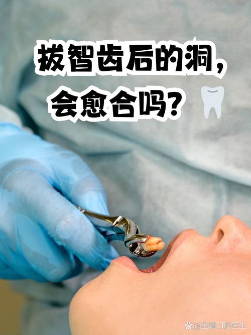 拔掉智齿后,是否都需要种牙来修复?-图1 拔掉智齿后,是否都需要种牙来修复?-图1