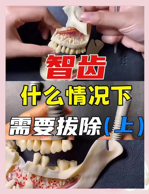 拔掉智齿后,是否都需要种牙来修复?-图2 拔掉智齿后,是否都需要种牙来修复?-图2