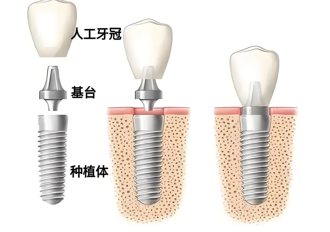 种半口种植牙的具体步骤有哪些？从术前到术后需经历哪些环节？-图2