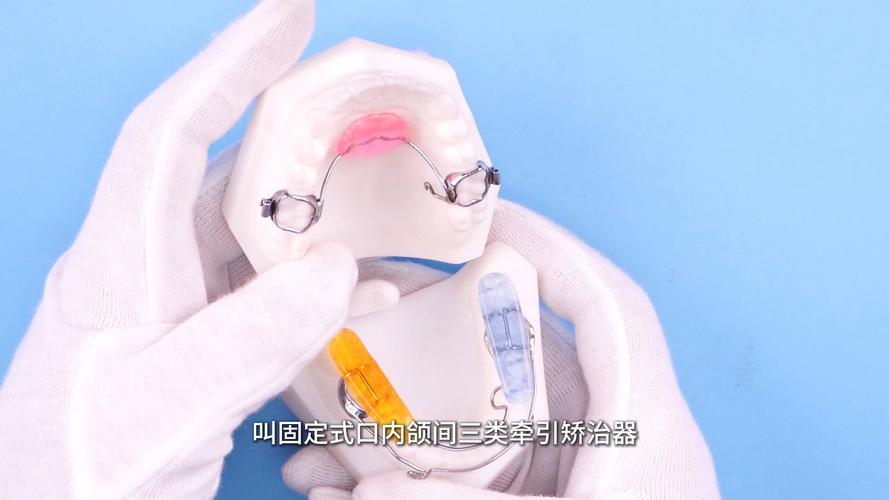 正畸牵引钩的最佳放置位置具体在口腔哪个部位?-图2 正畸牵引钩的最佳放置位置具体在口腔哪个部位?-图2