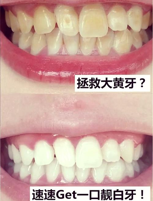 内源性黄牙变白方法-图3
