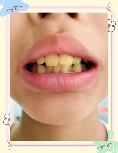 内源性黄牙变白方法-图2
