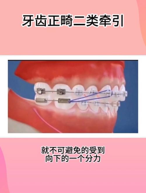 正畸中二类牵引的作用机制及临床应用效果是什么？-图3