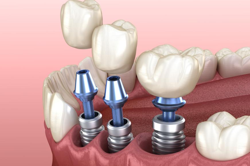 种植牙手术中笑气能用吗？安全性与适用情况解析？-图1