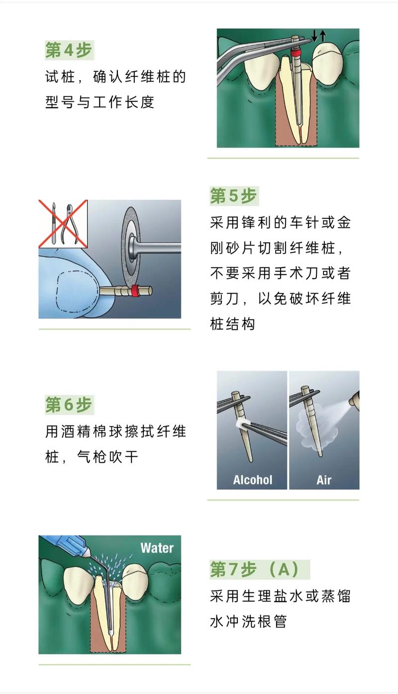 3M纤维桩粘接方法如何规范操作确保效果?-图1 3M纤维桩粘接方法如何规范操作确保效果?-图1