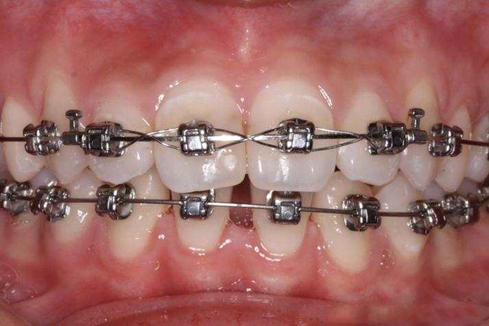 正畸矫治器的固位方式-图2 正畸矫治器的固位方式-图2