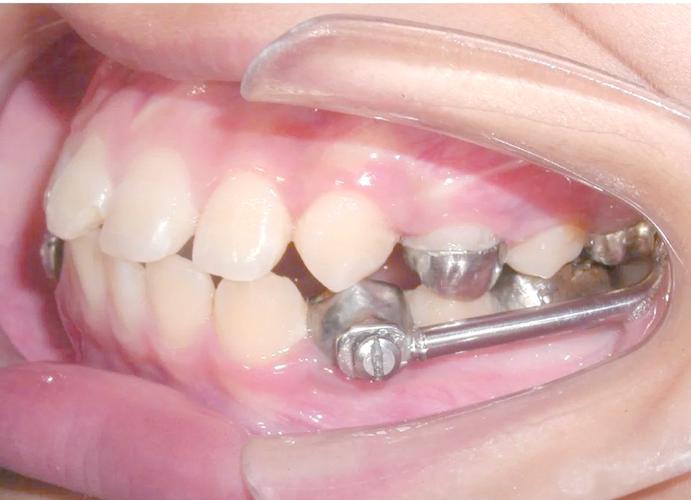 正畸矫治器的固位方式-图3 正畸矫治器的固位方式-图3