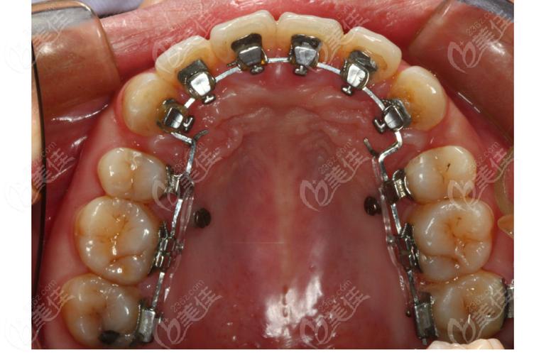 数字化舌侧矫正如何实现精准高效与舒适兼顾？-图2
