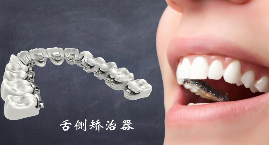 数字化舌侧矫正如何实现精准高效与舒适兼顾？-图1