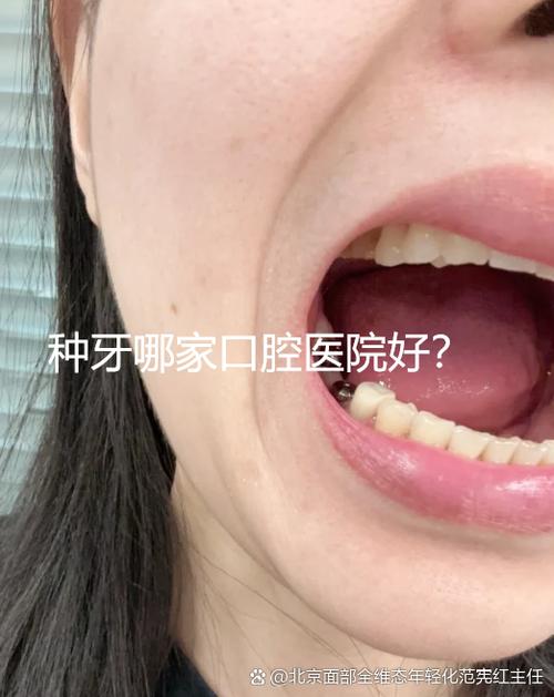 种牙能刷医保卡吗?-图1 种牙能刷医保卡吗?-图1