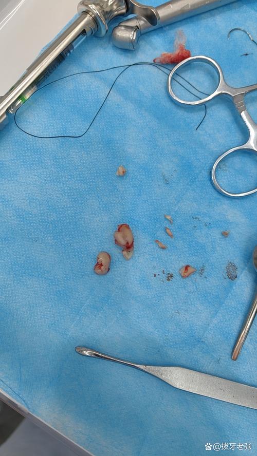 智齿拔了后要种牙吗-图2