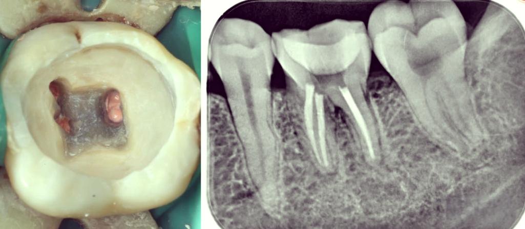 硅橡胶桩核取出方法有哪些？-图2