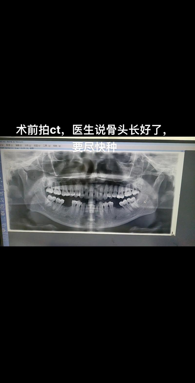 种牙后牙槽骨会长吗-图2