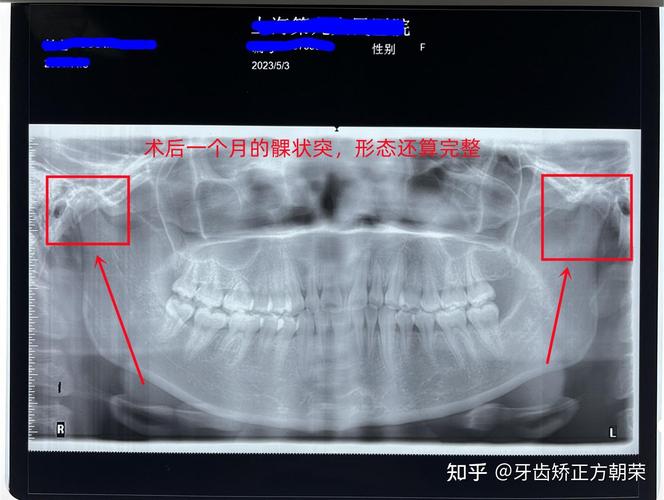 下颌骨X线投照方法的选择与操作要点有哪些?-图1 下颌骨X线投照方法的选择与操作要点有哪些?-图1