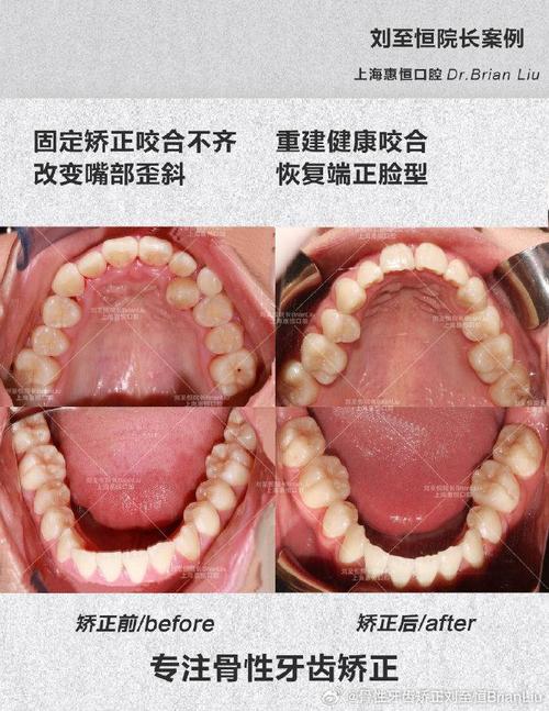 牙齿拥挤矫正方法有哪些？如何选择适合自己的矫正方式？-图2