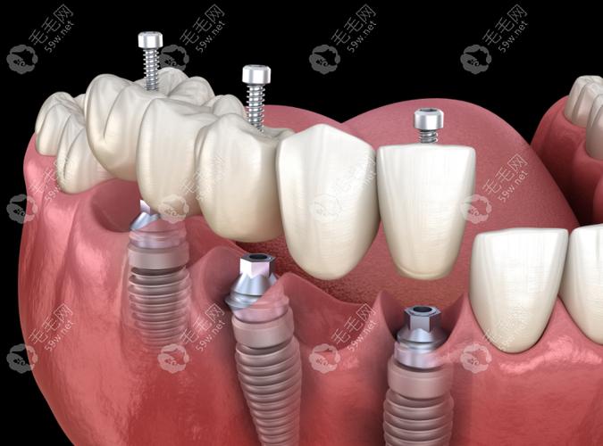 深圳即种半口种植牙，即刻种植半口牙的优势与效果如何？-图2