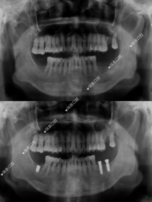 种牙能做CT检查吗?-图1 种牙能做CT检查吗?-图1
