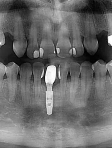 种牙能做CT检查吗?-图2 种牙能做CT检查吗?-图2