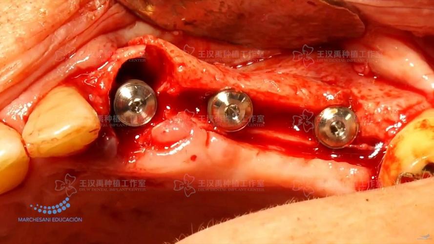 上颌后牙偏腭侧种牙-图3