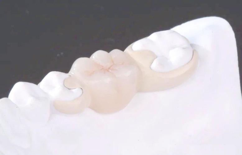 种牙与粘结桥,哪种牙齿修复方式更优?-图1 种牙与粘结桥,哪种牙齿修复方式更优?-图1