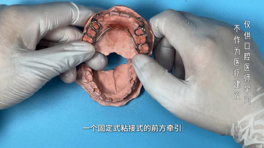 正畸牵引器正确戴法是什么?详细步骤有哪些?-图1 正畸牵引器正确戴法是什么?详细步骤有哪些?-图1