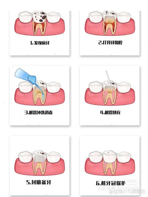 微创治疗牙髓炎方法-图2 微创治疗牙髓炎方法-图2