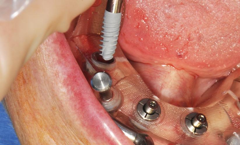 全口牙掉了要种几颗-图2