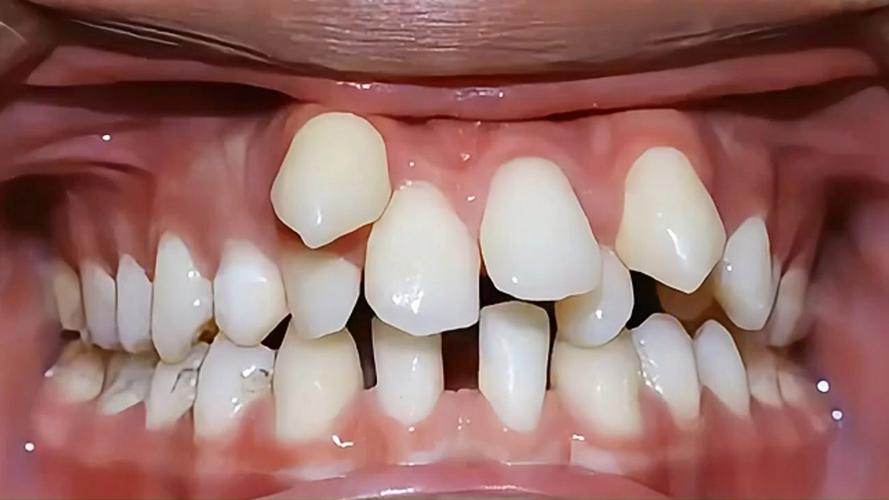 正畸矫正过程中下排牙齿歪了，是什么原因导致的？如何处理？-图1