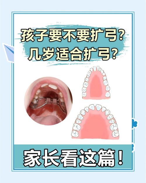 正畸扩弓有哪几种方法?如何选择适合自己的?-图2 正畸扩弓有哪几种方法?如何选择适合自己的?-图2