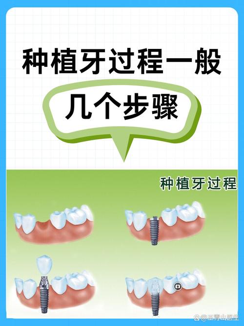 要种植全口牙怎么种-图1