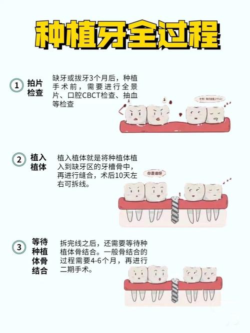 要种植全口牙怎么种-图2