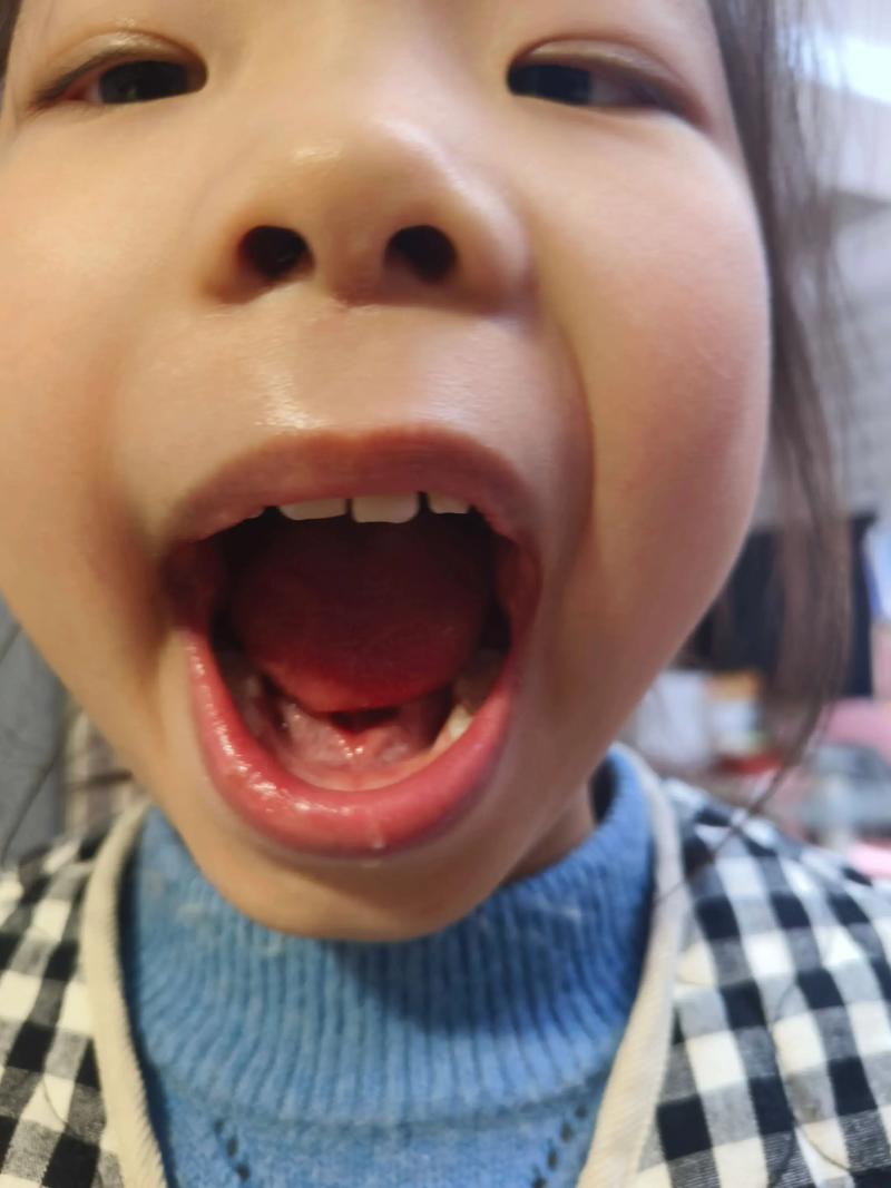 没门牙用哪种方法好-图2 没门牙用哪种方法好-图2