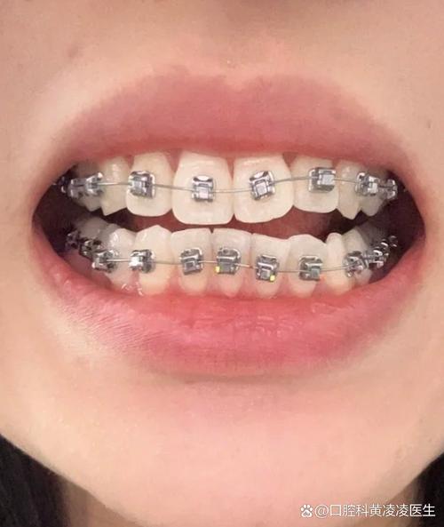 牙齿正畸能改变翘下巴-图2 牙齿正畸能改变翘下巴-图2