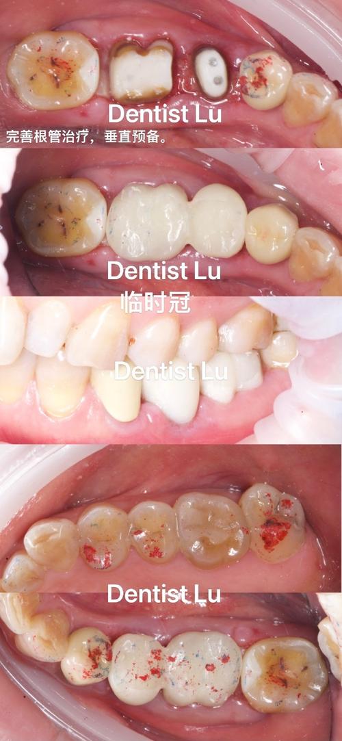 根管治疗后做牙冠正畸-图3 根管治疗后做牙冠正畸-图3