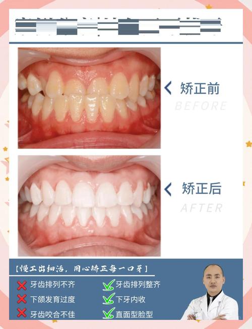 地包天牙齿正畸费用多少?影响因素有哪些?大概价格范围是多少?-图3 地包天牙齿正畸费用多少?影响因素有哪些?大概价格范围是多少?-图3