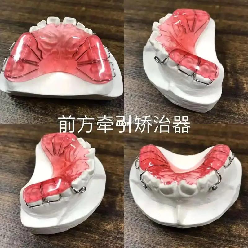 正畸前方牵引器图片展示了哪些佩戴和使用要点?-图1 正畸前方牵引器图片展示了哪些佩戴和使用要点?-图1